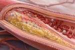 Un antiguo fármaco contra la artritis reduce la aterosclerosis en animales y muestra una señal favorable en pacientes 10 arteria con placa aterosclerotica
